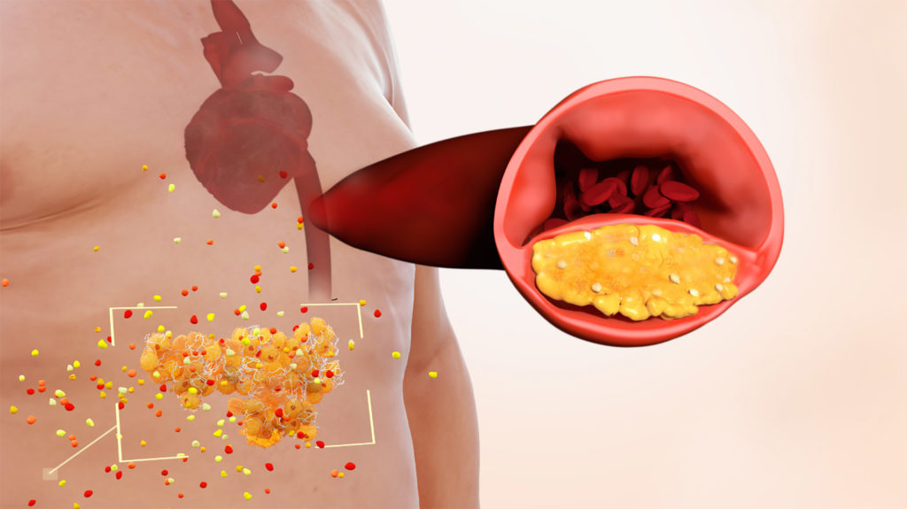 Kolesterol – Hovedbilde - Blodsjekk