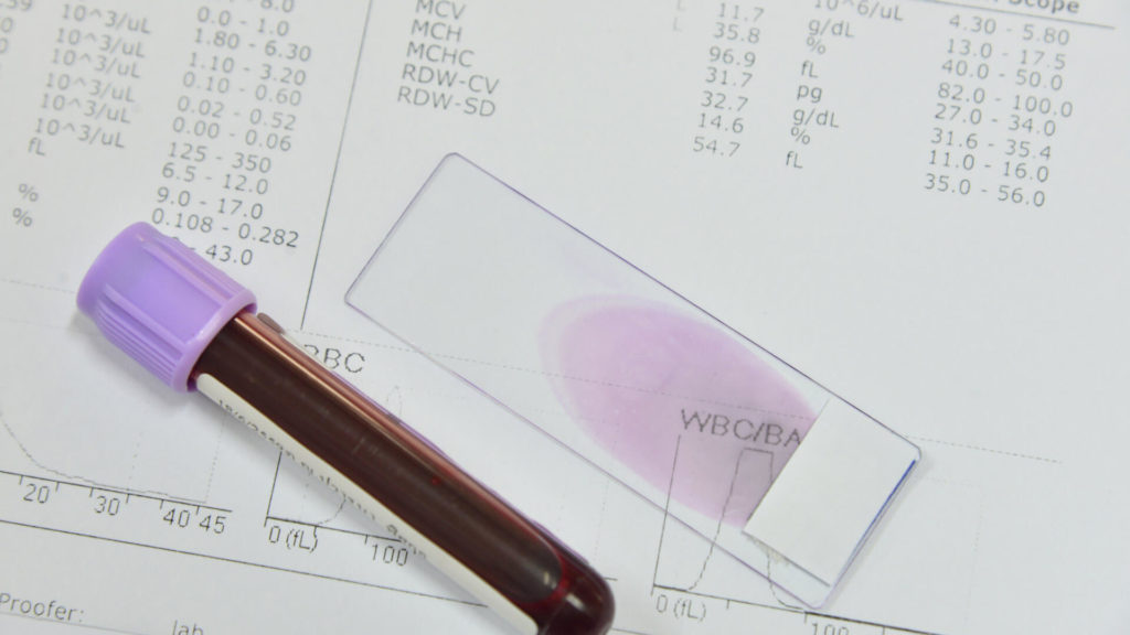 Lav blodprosent - Blodprøve - Blodsjekk