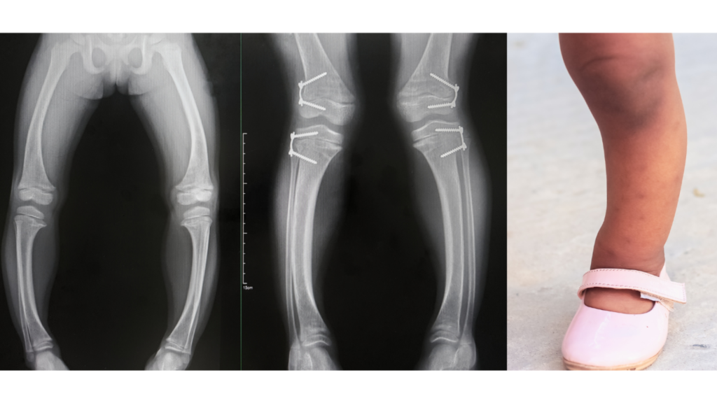 Alvorlig mangel på vitamin D kan føre til deformiteter i skjelettet, som buede lår- og leggbein.