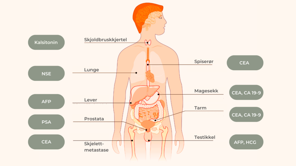 En kreftmarkør, også kalt tumormarkør, er noe som skiller kreftceller fra alle andre celler i kroppen. 