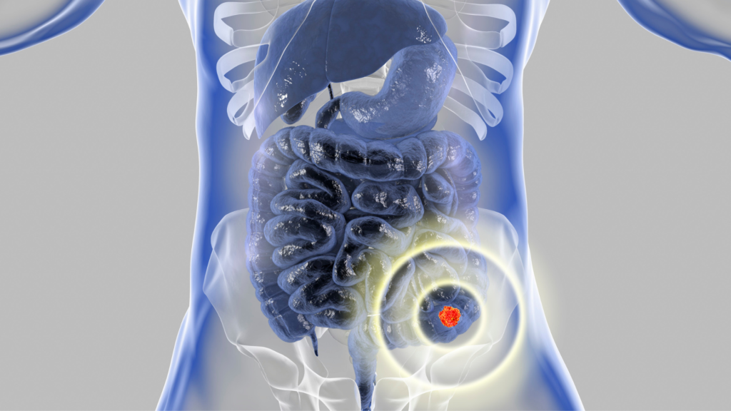 Tarmkreft er den nest vanligste kreften i Norge