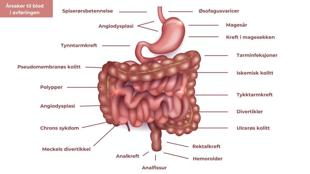Blod i avføringen kan stamme fra tilstander i hele fordøyelseskanalen