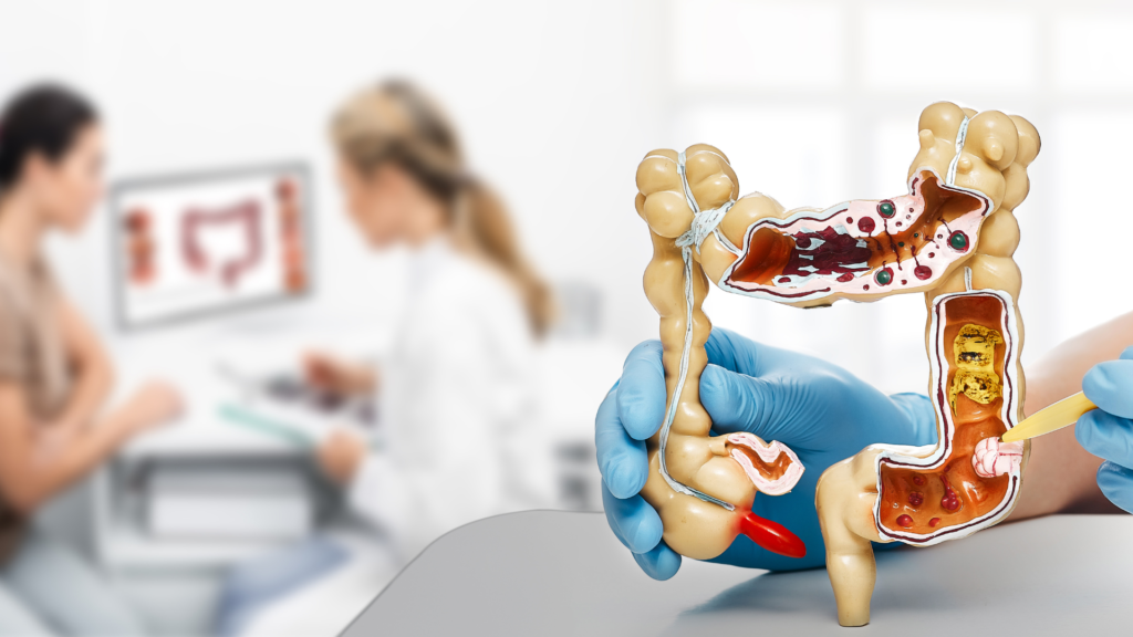 De aller fleste kolorektalsvulstene er lokalisert til nedre del av tykktarmen eller i endetarmen. 