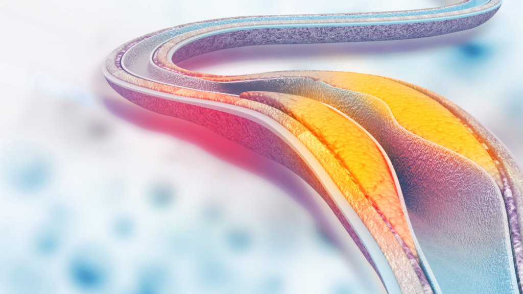 For høyt nivå av liporpotein LDL føre til avleiring av kolesterol i blodårene (arteriosklerose)