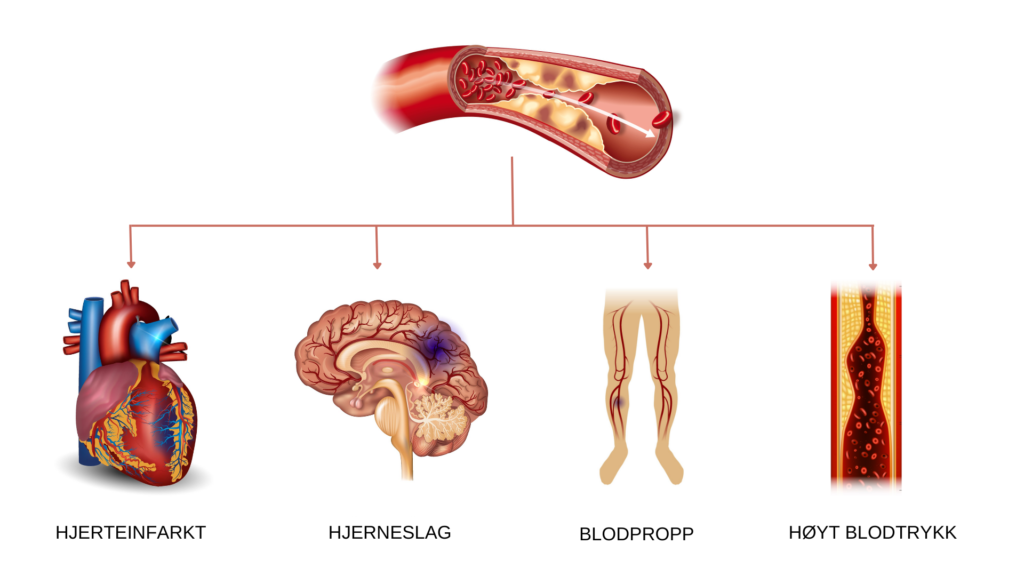 Høye nivåer av triglyserider kan føre til avleiring i blodåreveggen og dårlig gjennomstrømning til kroppens organer.