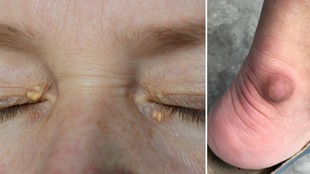 Ved betydelig høye nivåer av triglyserider kan det oppstå fettkuler i hud og senere, såkalte xanthomer og xanthelasmer.