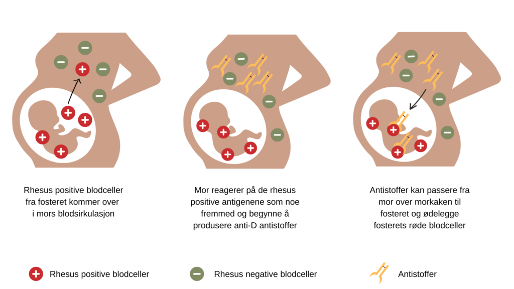 Hvis mor er RhD negativ og fosteret er RhD positivt, har dette betydning for oppfølging i svangerskapet.