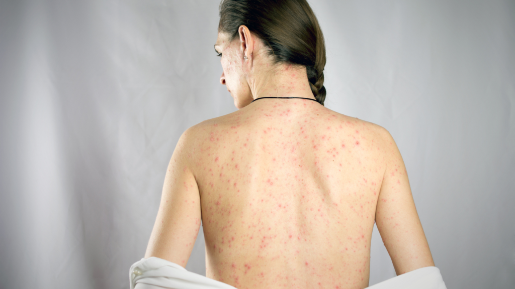 Å få røde hunder i svangerskapet kan føre til alvorlig fosterskade, fosterdød under svangerskapet og spontanabort.