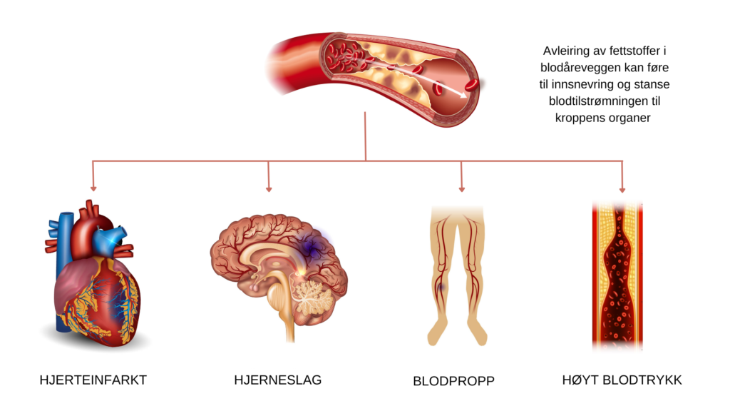 Metabolsk syndrom fører til ugunstig lipidprofil som gir økt risiko for hjerte-karsykdom