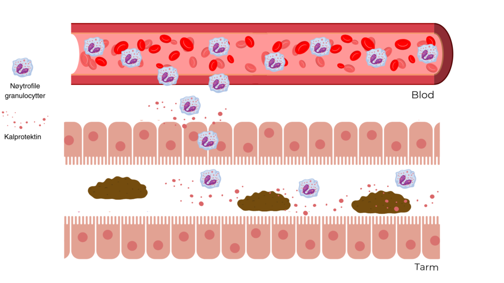 Kalprotektin er et protein med antimikrobiell effekt og konsentrasjonen av fekal kalprotektin er en god markør for betennelse i tarmslimhinnen.
