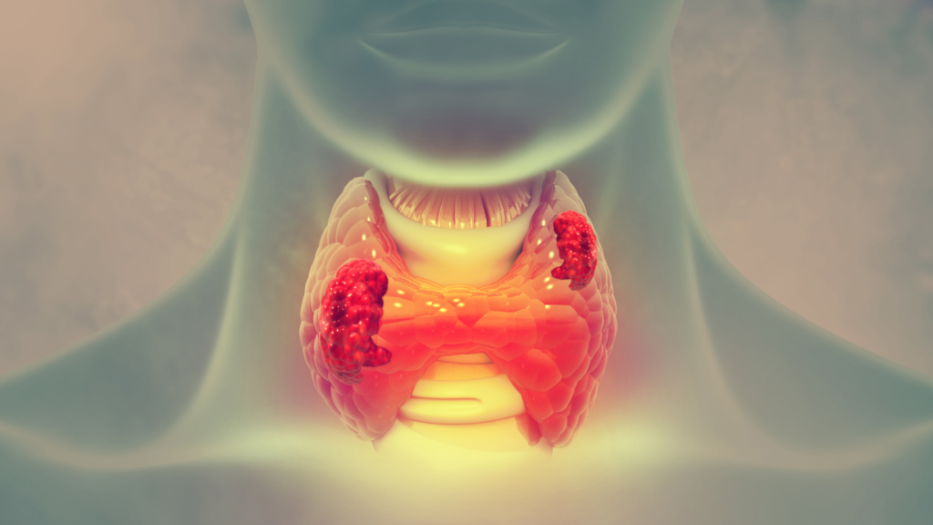 Høyt stoffskifte kan skyldes at skjoldbruskkjertelen går over til egenproduksjon av tyroksin i hormonaktive knuter i kjertelen
