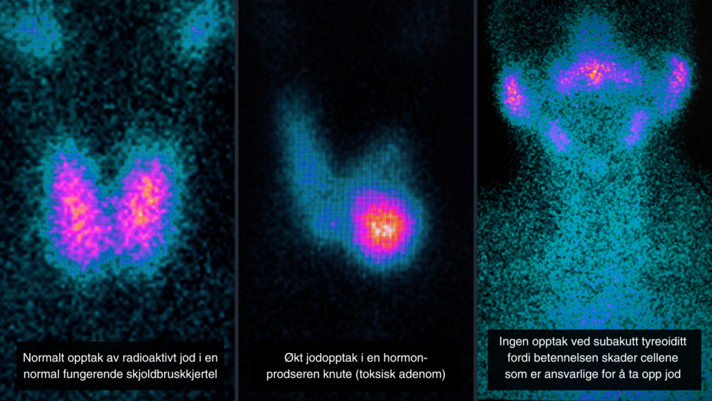 Ved scintigrafi sprøytes en liten mengde radioaktivt jod inn i blodet for å måle hvor godt skjoldbruskkjertelen tar opp jodet